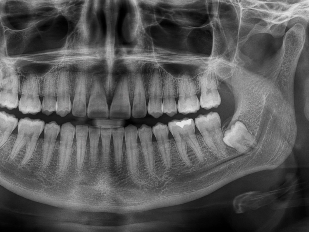 Terceiro molar próximo ao canal mandibular: quando a tomografia realmente muda a conduta
