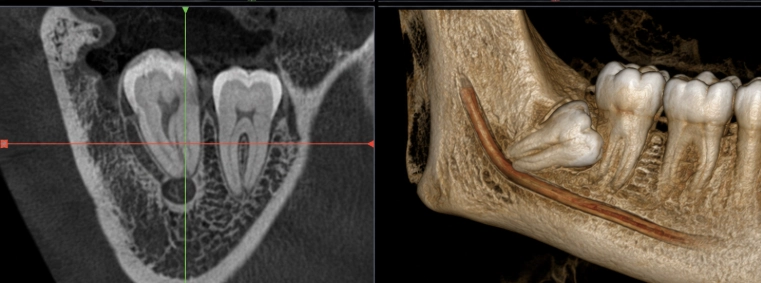 Terceiro molar próximo ao canal mandibular: quando a tomografia realmente muda a conduta